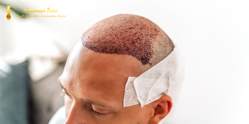 Hair Transplant: Orange Tree Aesthetics
