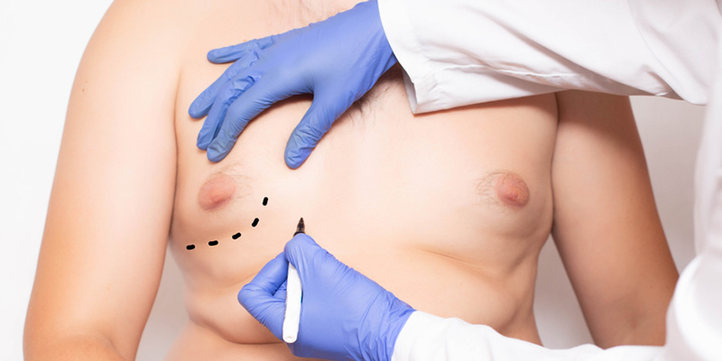 Who is the best doctor to treat gynecomastia in New Delhi?