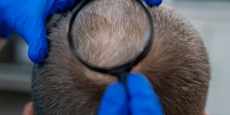 How To Improve The Success Rate of Hair Transplant Surgery?