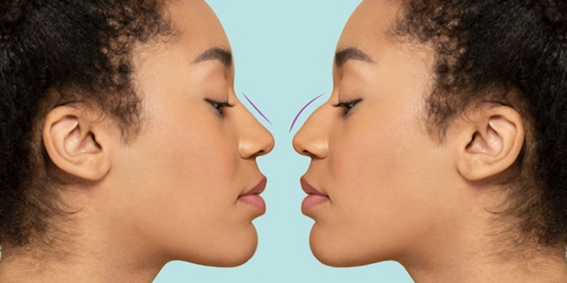 What is the difference between rhinoplasty and septoplasty?