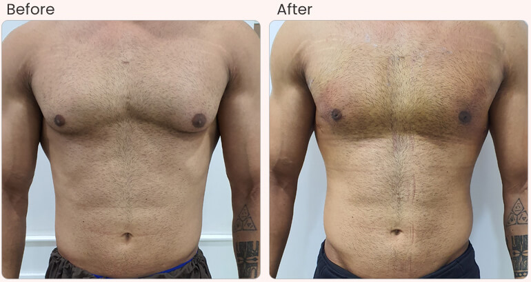 Top Myths About Male Breast Reduction You Need to Stop Believing
