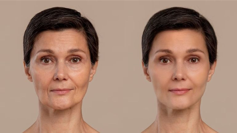 Facelift Cost in India