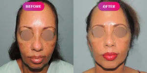 cost of face lift 