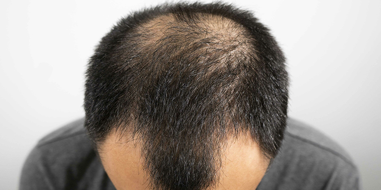Is Hair Restoration An Effective Solution For Androgenetic Alopecia?
