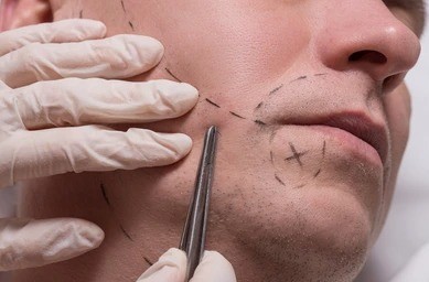 Moustache transplant