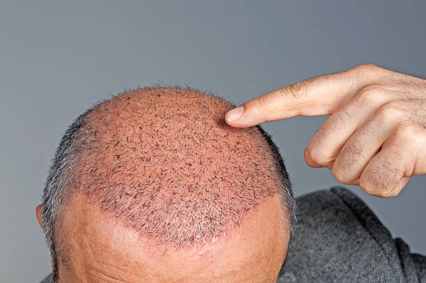 Can a Hair Transplant Fix Receding Hairlines in Younger Men? Expert Guide 2025