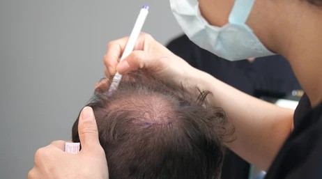 Best Age for Hair Transplant: When Should You Consider It?