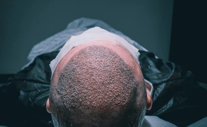 Hair Transplant Cost Per Graft in India: What Clinics Don’t Tell You