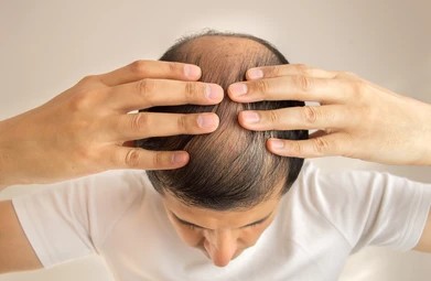 Is Hair Restoration An Effective Solution For Androgenetic Alopecia?