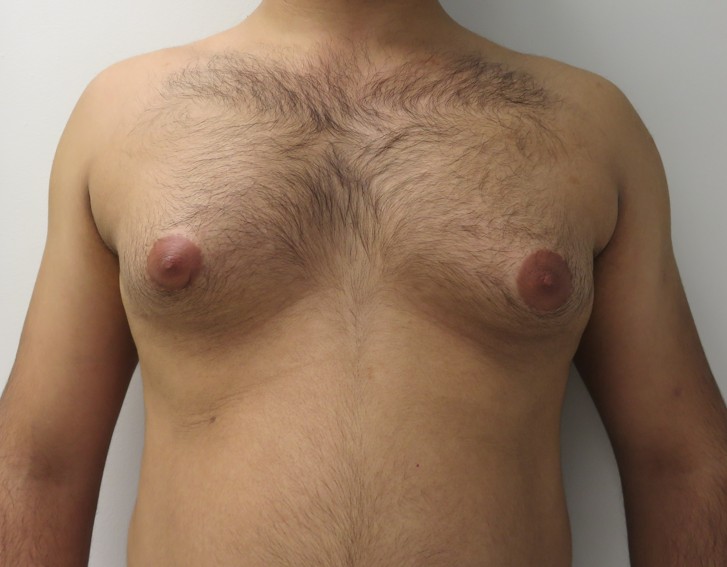 Best Gynecomastia Surgeon in Delhi: How to Choose the Right Doctor