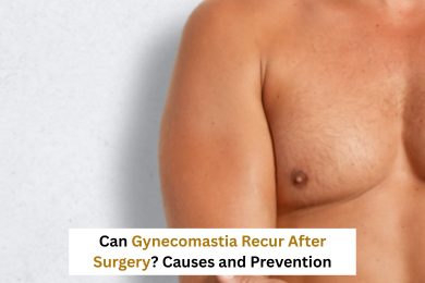 Can Gynecomastia Recur After Surgery? Causes and Prevention