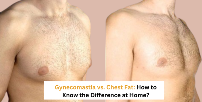 Gynecomastia vs Chest Fat