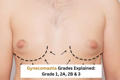 Gynecomastia Grades Explained: Grade 1, 2A, 2B & 3