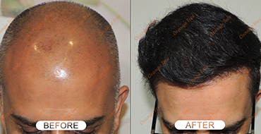 Affordable Hair Transplant Service In Delhi