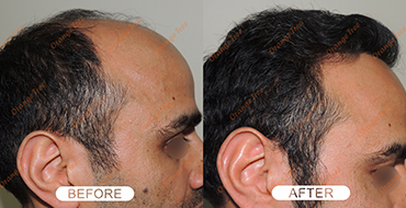 hair transplant surgeons in Delhi
