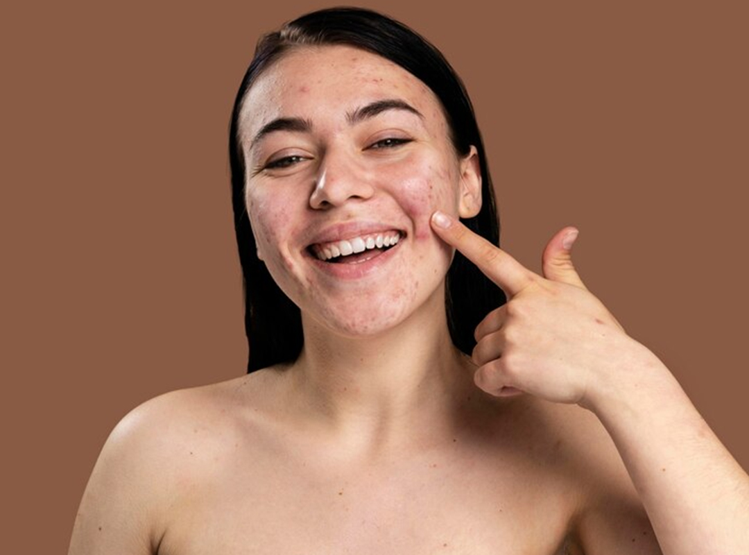 acne-scar-treatment.jpg